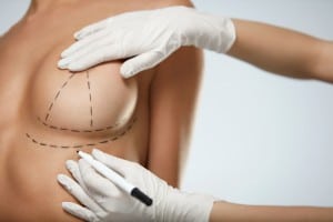 breast surgery diagram