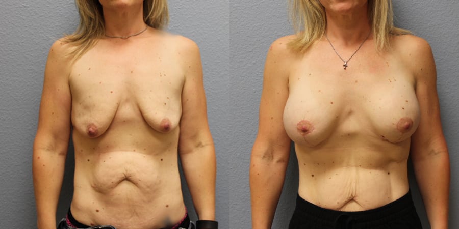 Breast Lift actual patient results