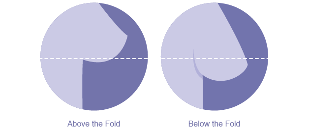 Breast Lift Diagram