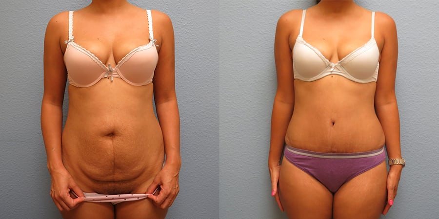 Tummy Tuck before an after patient