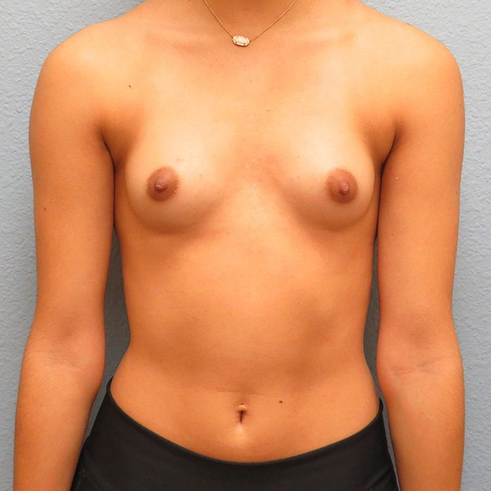 Breast Augmentation Patient Before 1