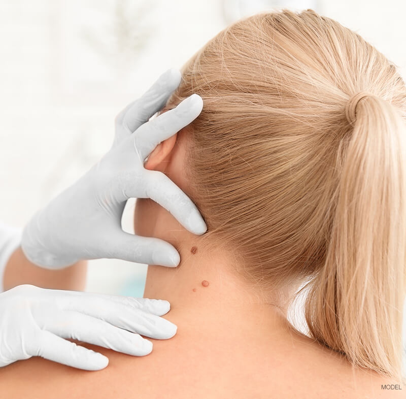 Doctor inspection woman's moles