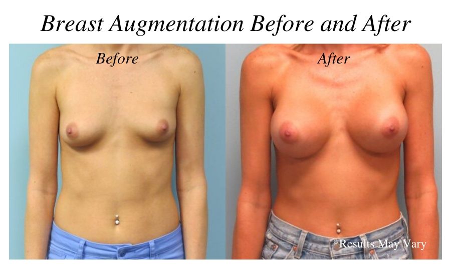 Before and after imaging showing the results of a breast augmentation performed in Corpus Christi, Texas.