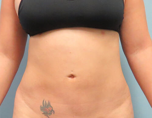 Liposuction in Corpus Christi, TX Patient After 2