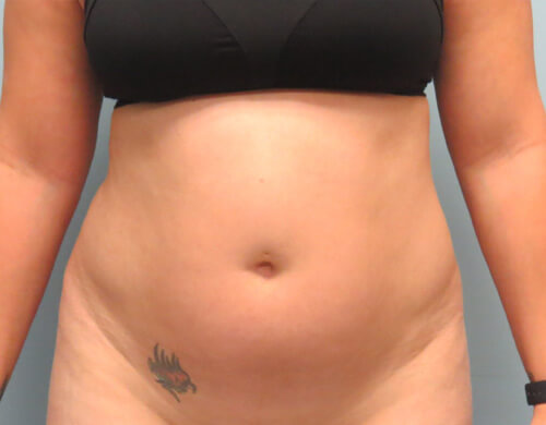 Liposuction in Corpus Christi, TX Patient Before 1