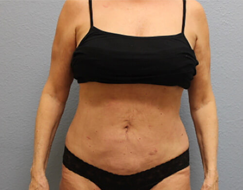 Liposuction in Corpus Christi, TX Patient After 4