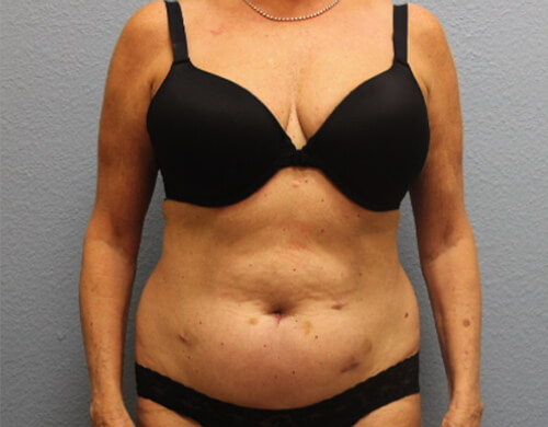 Liposuction in Corpus Christi, TX Patient Before 3