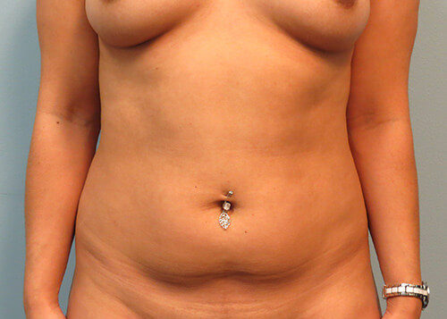Liposuction in Corpus Christi, TX Patient Before 5