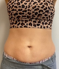 CoolSculpting® Elite in Corpus Christi, TX Patient After 2