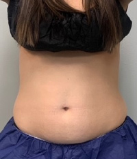 CoolSculpting® in Corpus Christi, TX Patient Before 1
