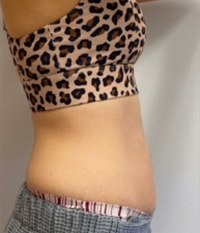 CoolSculpting® Elite in Corpus Christi, TX Patient After 4