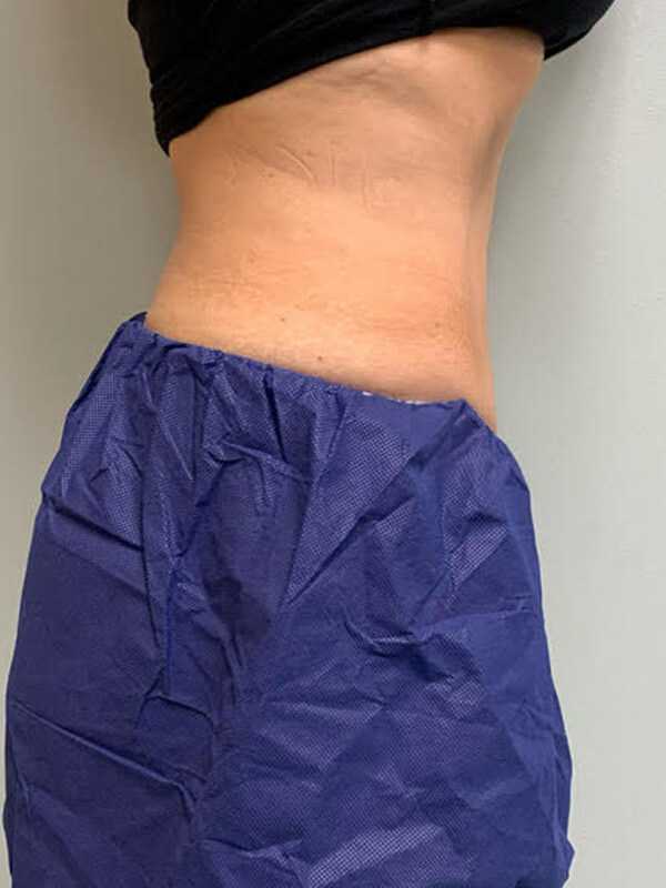 CoolTone® by CoolSculpting® in Corpus Christi, TX Patient After 4