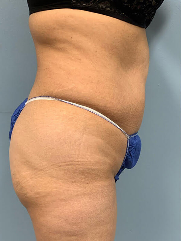 CoolTone® by CoolSculpting® in Corpus Christi, TX Patient Before 3