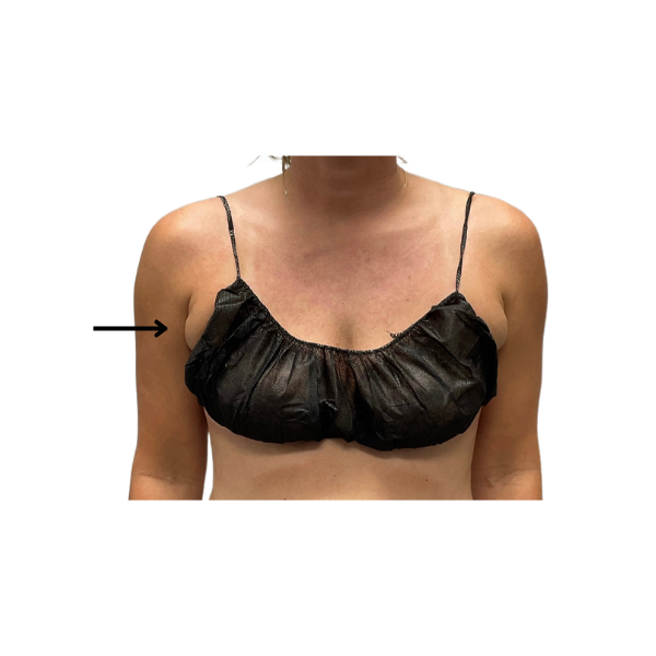 CoolSculpting® Elite in Corpus Christi, TX Patient Before 1