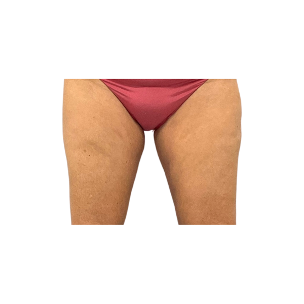 CoolSculpting® Elite in Corpus Christi, TX Patient After 4