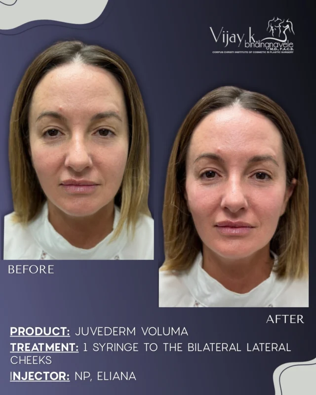 iv glutathione drip corpus christi tx Sculptra® Aesthetic | Complejo B How to Reconstitute Glutathione Size:1000 mcg/ml - 10 ml x 5
